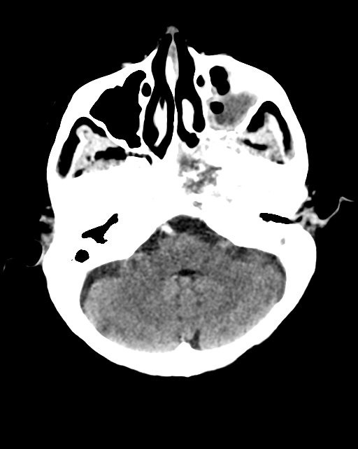 Nasopharyngeal carcinoma with cerebral abscess (Radiopaedia 43018-46275 Axial C+ delayed 13).png