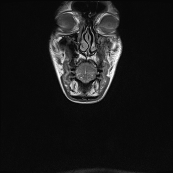 Nasopharyngeal carcinoma with skull base invasion (Radiopaedia 53415-59485 Coronal T1 39).jpg