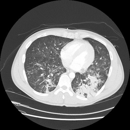 Near-drowning pulmonary edema (Radiopaedia 59457-66814 Axial lung window 39).jpg