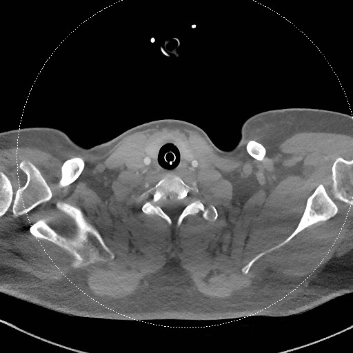 Neck CT angiogram (intraosseous vascular access) (Radiopaedia 55481-61945 B 128).jpg