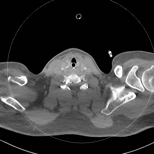 Neck CT angiogram (intraosseous vascular access) (Radiopaedia 55481-61945 B 145).jpg