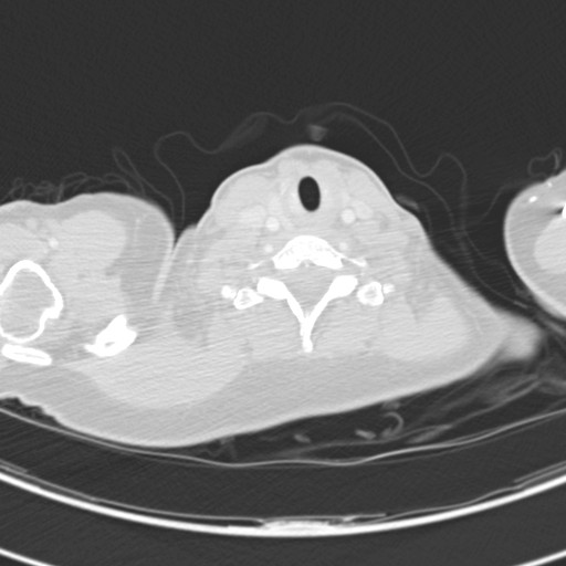 Necrobiotic pulmonary nodules - Crohn disease (Radiopaedia 20723-20631 Axial lung window 2).jpg
