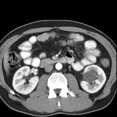 File:Necrotizing pancreatitis with acute necrotic collection (Radiopaedia 14470-14417 B 22).jpg