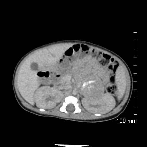 File:Neonatal neuroblastoma (Radiopaedia 56651-63438 Axial non-contrast 34).jpg