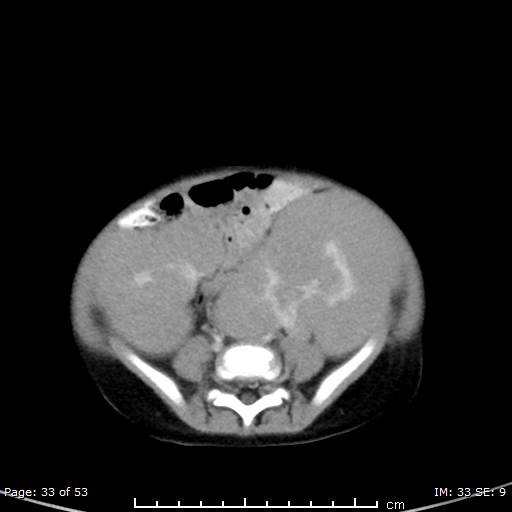 File:Nephroblastomatosis (Radiopaedia 41934-44935 A 33).jpg