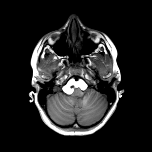 Neurenteric cyst (Radiopaedia 58641-65837 Axial T1 13).png