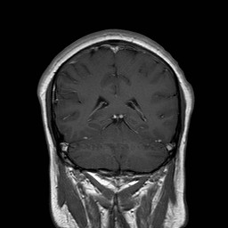 File:Neuro-Behcet's disease (Radiopaedia 21557-21505 Coronal T1 C+ 15).jpg