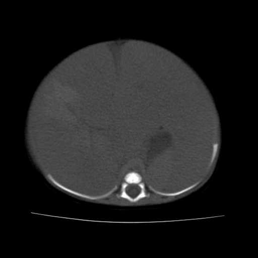 File:Neuroblastoma (Radiopaedia 20876-20799 Axial non-contrast 8).jpg