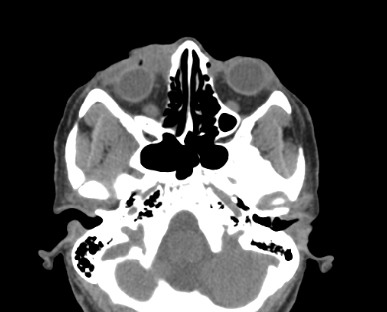 Neurofibromatosis type 1- orbital manifestations (Radiopaedia 49391-54511 Axial non-contrast 40).jpg