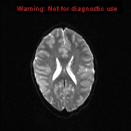 File:Neurofibromatosis type 1 with optic nerve glioma (Radiopaedia 16288-15965 Axial DWI 9).jpg