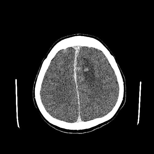 File:Neurofibromatosis type 2 (Radiopaedia 25389-25637 Axial C+ 73).jpg