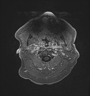 Neurofibromatosis type 2 (Radiopaedia 79097-92049 Axial T1 C+ 4).jpg
