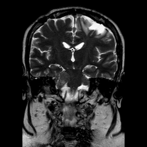 File:Neurofibromatosis type 2 (Radiopaedia 8713-9518 Coronal T2 14).jpg