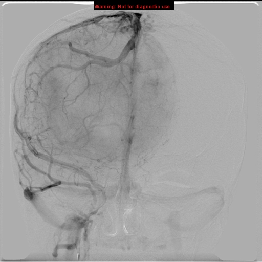 File:Neurofibromatosis type 2 (Radiopaedia 8953-9733 D 23).jpg