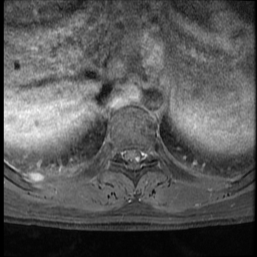File:Neurofibromatosis type 2 (spinal manifestations) (Radiopaedia 53943-60070 J 13).png