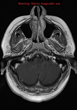 File:Neuroglial cyst (Radiopaedia 10713-11184 Axial T1 C+ 20).jpg