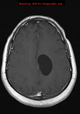File:Neuroglial cyst (Radiopaedia 10713-11184 Axial T1 C+ 8).jpg
