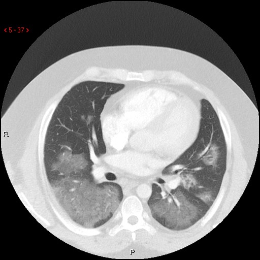 File:Non-specific interstitial pneumonitis (Radiopaedia 27044-27222 Axial lung window 28).jpg