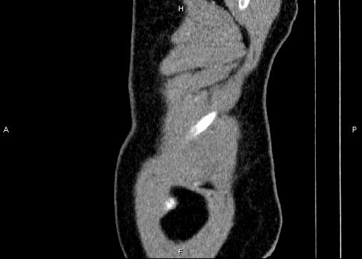 Non-syndromic pancreatic endocrine tumor (Radiopaedia 86958-103178 E 2).jpg