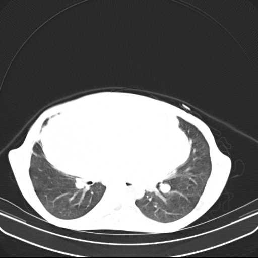 File:Non hodgkin lymphoma of the mediastinum (Radiopaedia 20814-20729 Axial lung window 29).jpg