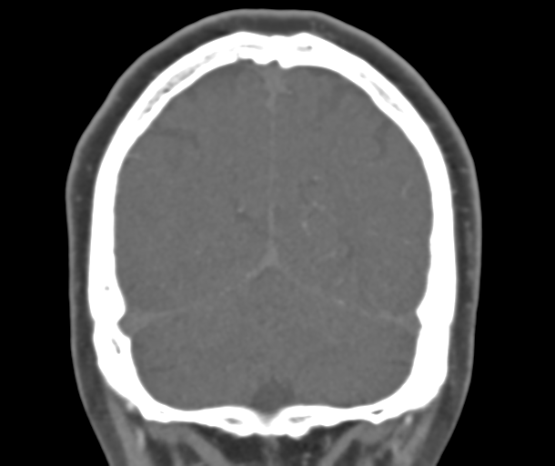 File:Normal CTA head (Radiopaedia 40801-43464 B 76).png