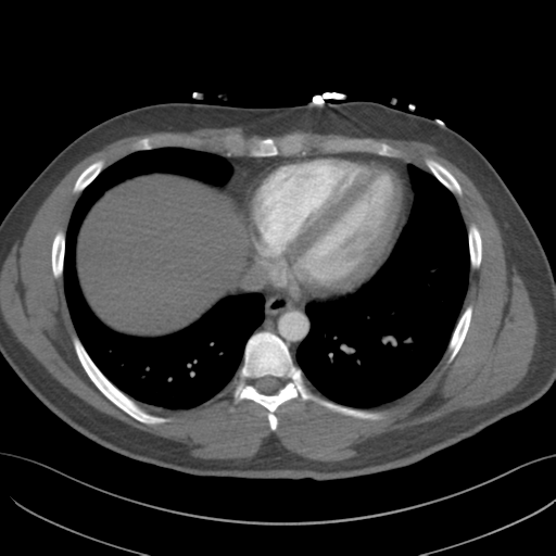 File:Normal CTA thorax (non ECG gated) (Radiopaedia 41750-44704 A 69).png