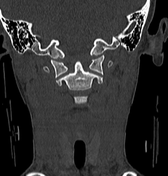 File:Normal CT cervical spine - 12-year-old (Radiopaedia 55352-61775 Coronal bone window 67).jpg