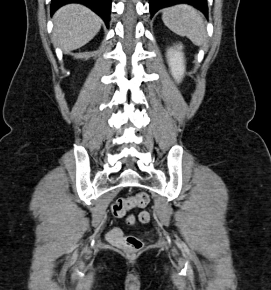 Normal CT intravenous urogram (Radiopaedia 39444-41759 A 344).jpg