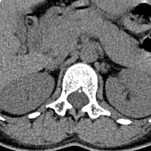 Normal CT lumbar spine (Radiopaedia 53981-60118 Axial non-contrast 17).jpg
