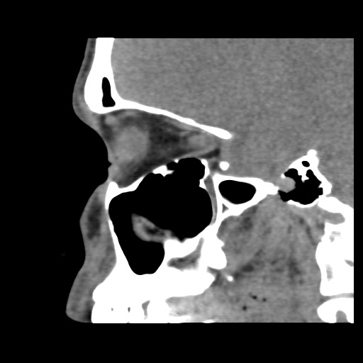 Normal CT paranasal sinuses (Radiopaedia 42286-45390 F 96).jpg