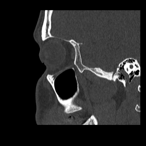 Normal CT paranasal sinuses (Radiopaedia 42286-45390 Sagittal bone window 19).jpg