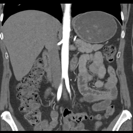 File:Normal CT renal artery angiogram (Radiopaedia 38727-40889 B 39).png