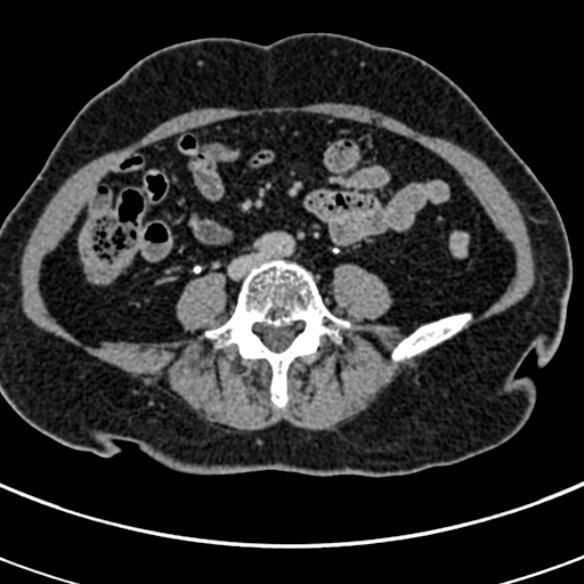 File:Normal CT split bolus study of the renal tract (Radiopaedia 48631-53634 Axial split bolus 165).jpg