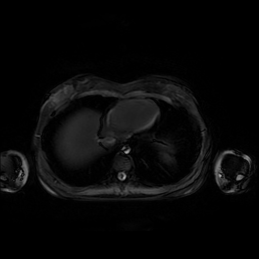 File:Normal MRI abdomen in pregnancy (Radiopaedia 88001-104541 D 5).jpg
