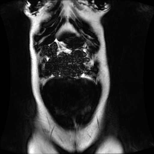 Normal MRI abdomen in pregnancy (Radiopaedia 88001-104541 N 34).jpg