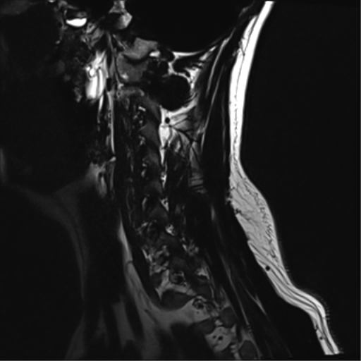 File:Normal MRI cervical spine (infection protocol) (Radiopaedia 53916-60039 F 3).png
