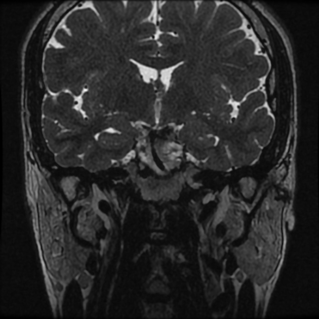 Normal MRI petrous (Radiopaedia 91317-108949 Coronal T2 21).jpg