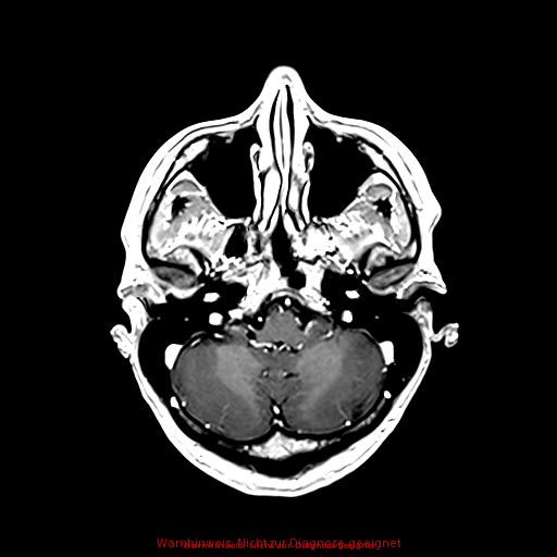 Normal adult brain MRI (non-enhanced and contrast-enhanced) (Radiopaedia 75262-86379 Axial T1 C+ 61).jpg