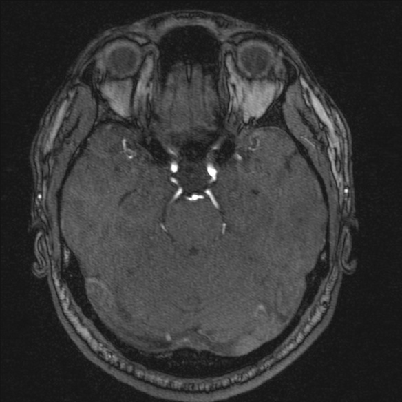 Normal brain MRI including MRA (Radiopaedia 48748-53763 Axial MRA 73).jpg