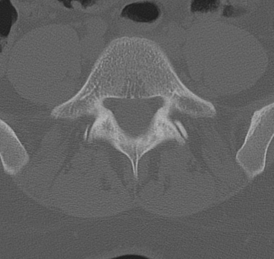 File:Normal lumbar spine CT (Radiopaedia 46533-50986 Axial bone window 59).png