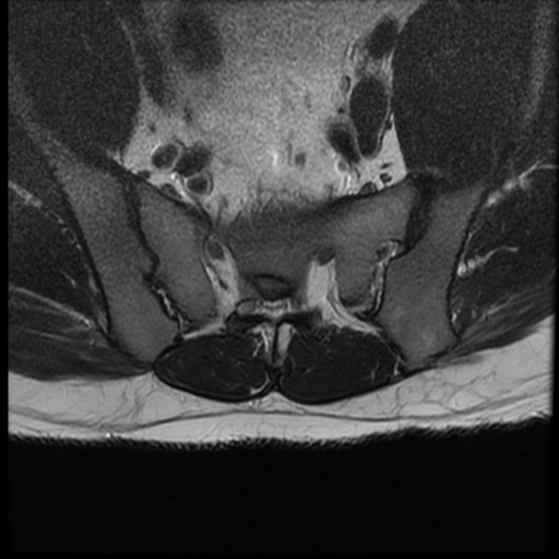 File:Normal lumbar spine MRI (Radiopaedia 35543-37039 Axial T2 1).png