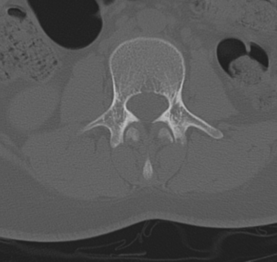 File:Normal lumbosacral CT (Radiopaedia 37923-39867 Axial bone window 51).png