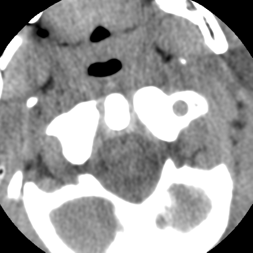 Normal trauma cervical spine (Radiopaedia 41017-43760 Axial non-contrast 13).png