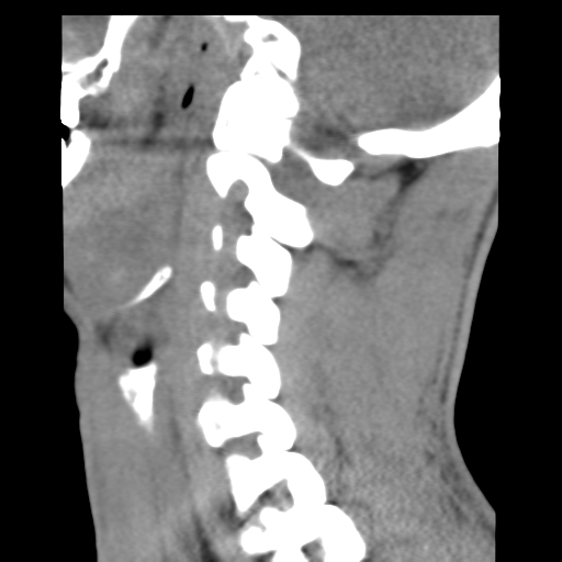 File:Normal trauma cervical spine (Radiopaedia 41017-43760 B 20).png