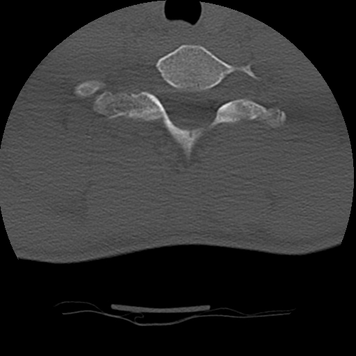 File:Normal trauma spine imaging (age 16) (Radiopaedia 45335-49358 Axial bone window 66).jpg