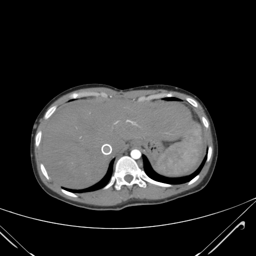 File:Nutmeg liver- Budd-Chiari syndrome (Radiopaedia 46234-50635 A 14).png