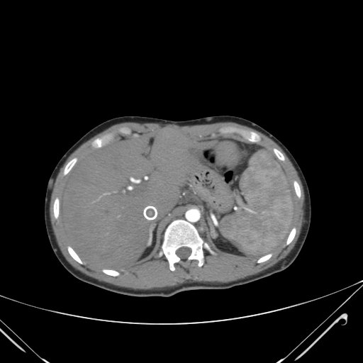 File:Nutmeg liver- Budd-Chiari syndrome (Radiopaedia 46234-50635 A 21).png