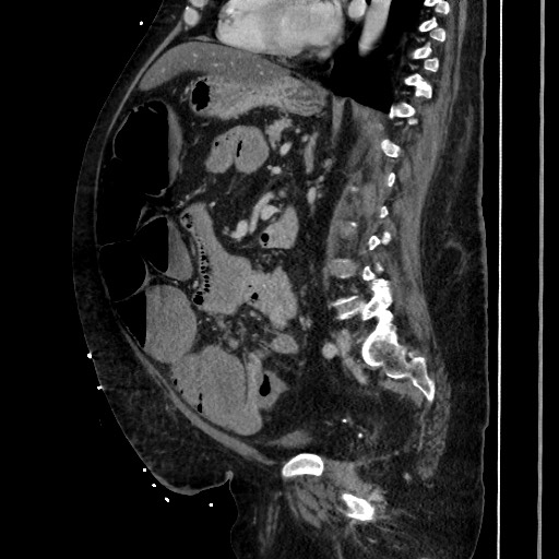 Obstructive colonic diverticular stricture (Radiopaedia 81085-94675 C 139).jpg