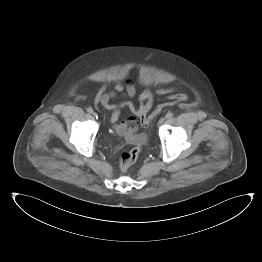 File:Obstructive pyelonephritis (Radiopaedia 46411-50844 Axial non-contrast 69).png