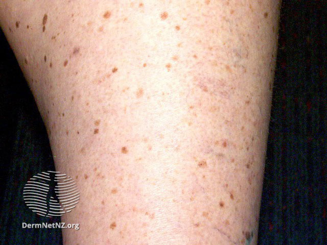 File:See more images of lentigines... (DermNet NZ lesions-lentigo5).jpg